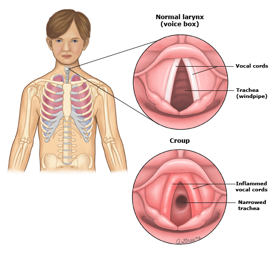 Child showing signs of respiratory distress that require immediate medical attention